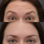 How Long Does Botox Last?