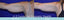 Coolsculpting Arm Before & After #4