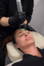 What Is Genius RF Microneedling?