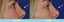 Non-Surgical Nose Job