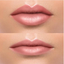 Why People Are Getting Lip Fillers Dissolved