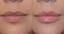 How Long Does Lip Filler Last? What to Expect by Filler Type