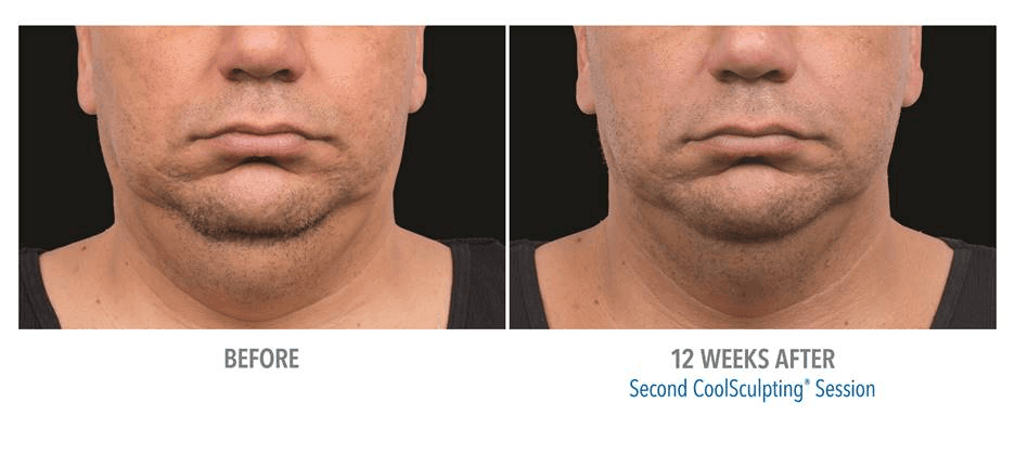 Coolsculpting-Double-Chin-Before---038--After--2