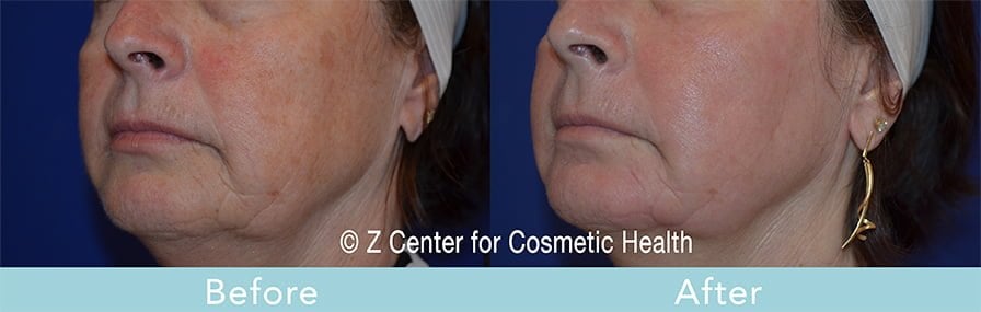 Laser Skin Resurfacing