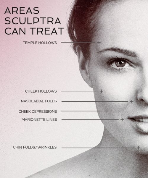 sculptra