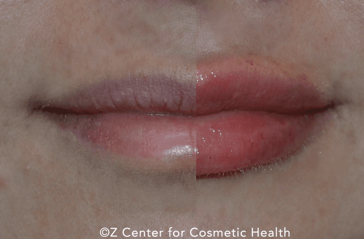 Lip Filler Myths Busted: Using Straws - Skin Deep Med Spa