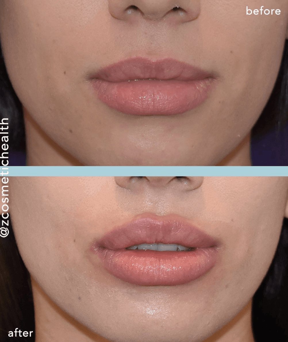 Lip Filler Myths Busted: Using Straws - Skin Deep Med Spa