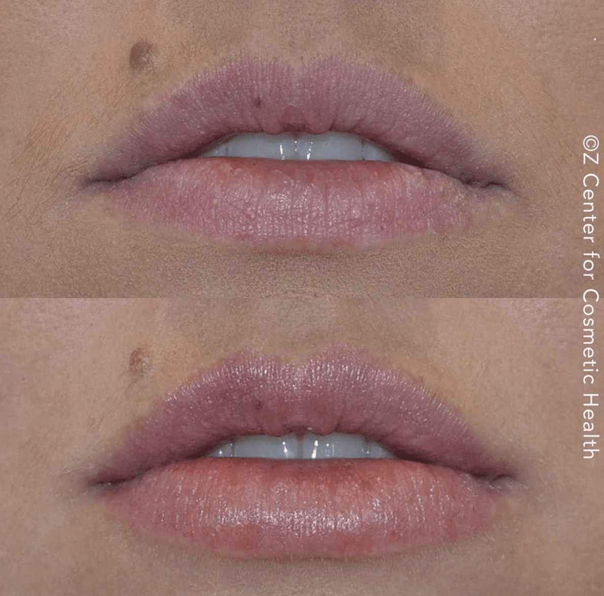 Lip Filler Myths Busted: Using Straws - Skin Deep Med Spa