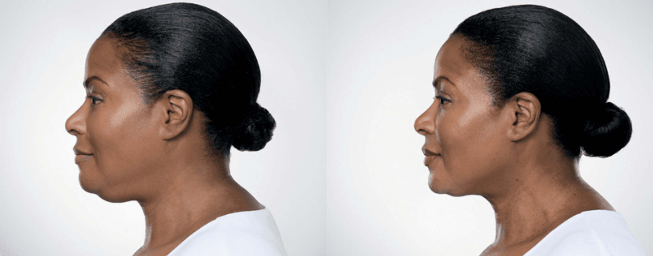 top jawline treatments