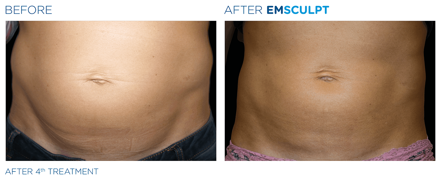 emsculpt and ab conditioning