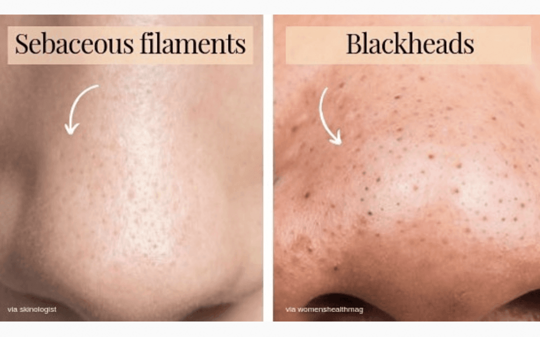 Sebaceous Filaments vs. Blackheads