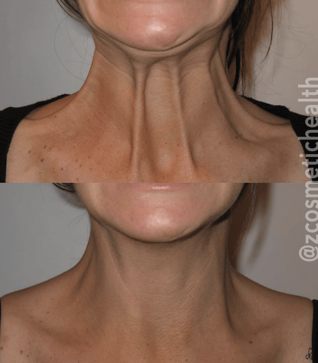 Try These Treatments for Neck Bands | Z Cosmetic Health Blog