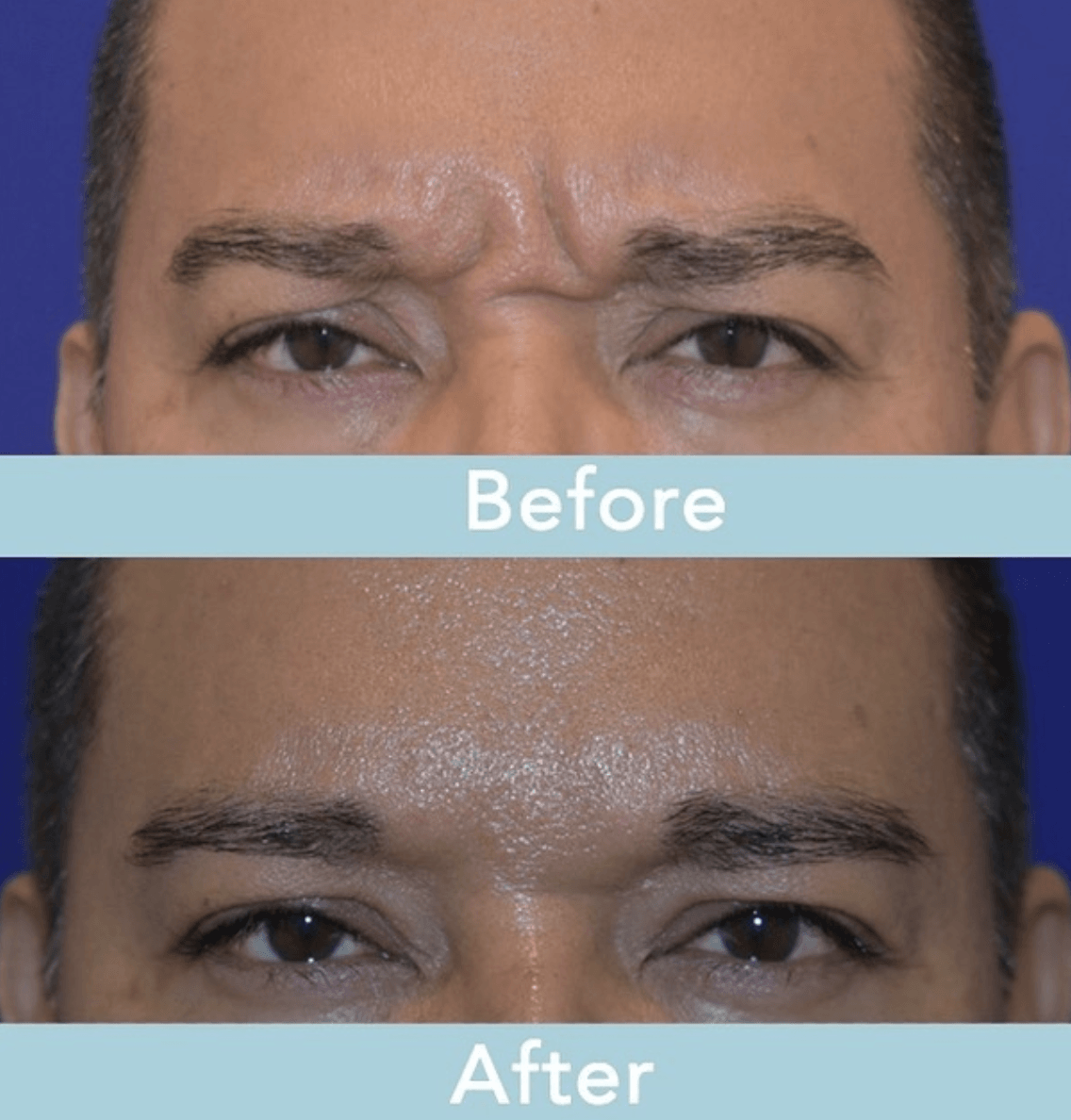 Muscle Used To Form The Horizontal Frown Crease On The Forehead