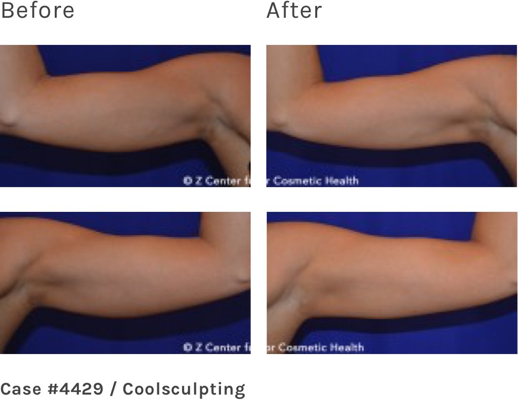 Patient-Case--4429---Coolsculpting