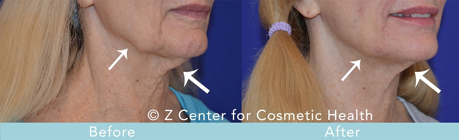 How to Achieve a Chiseled Jawline - Zcosmetic Health