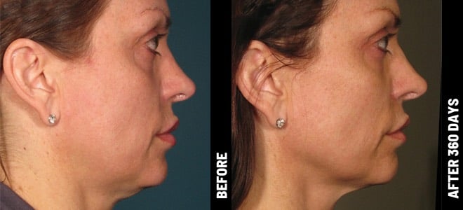 How To Get A Chiseled Jawline Without Any Surgery?