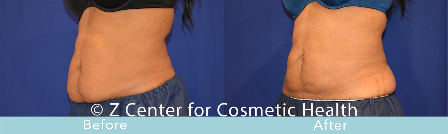 Coolsculpting-Abdomen-Before---038--After--35