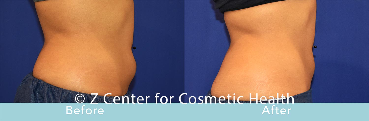 Coolsculpting-Abdomen-Before---038--After--34