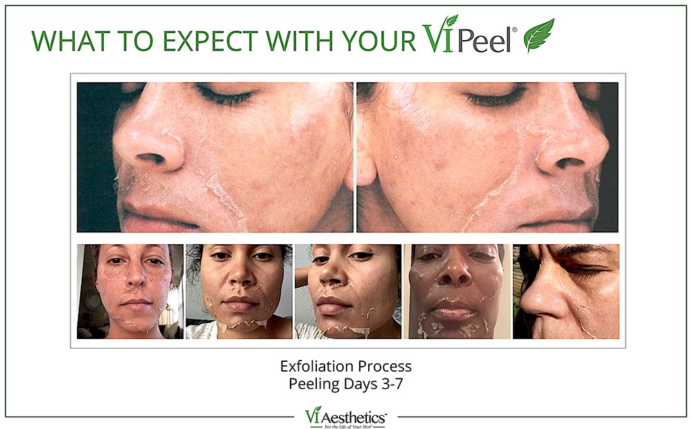 What Is A VI Peel