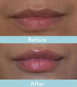 Lips Before & After