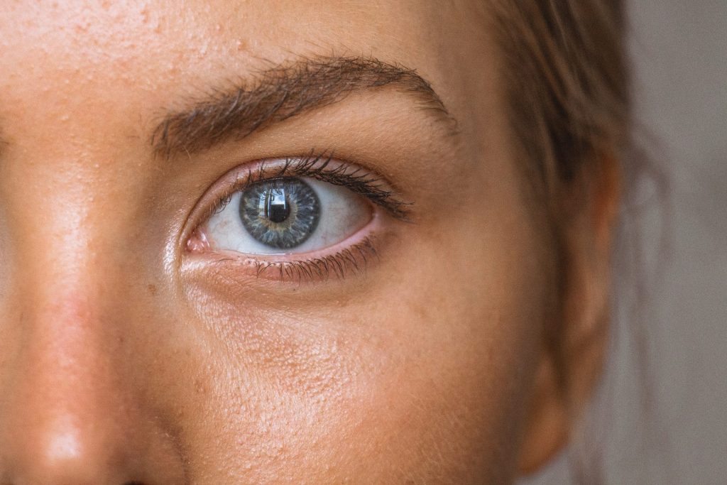 dark eye circles