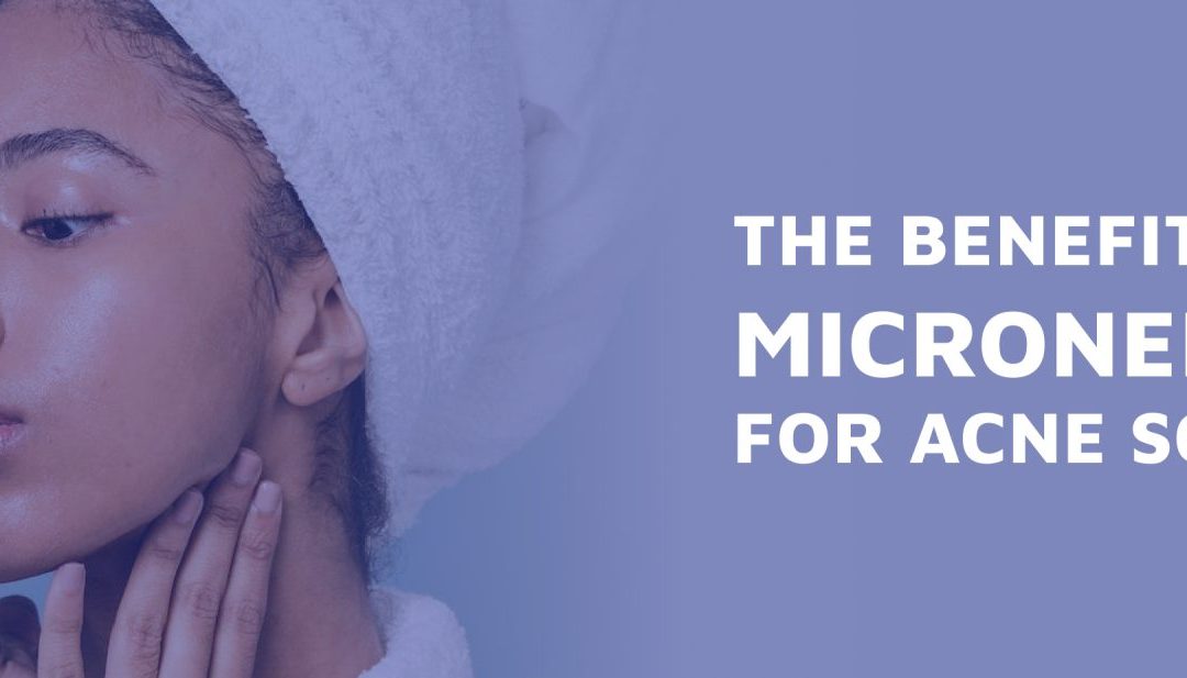 The Benefits of Microneedling For Acne Scars